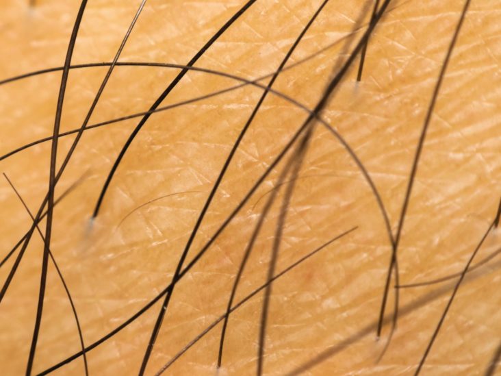 Pubic hair loss: Causes, other symptoms, and treatments
