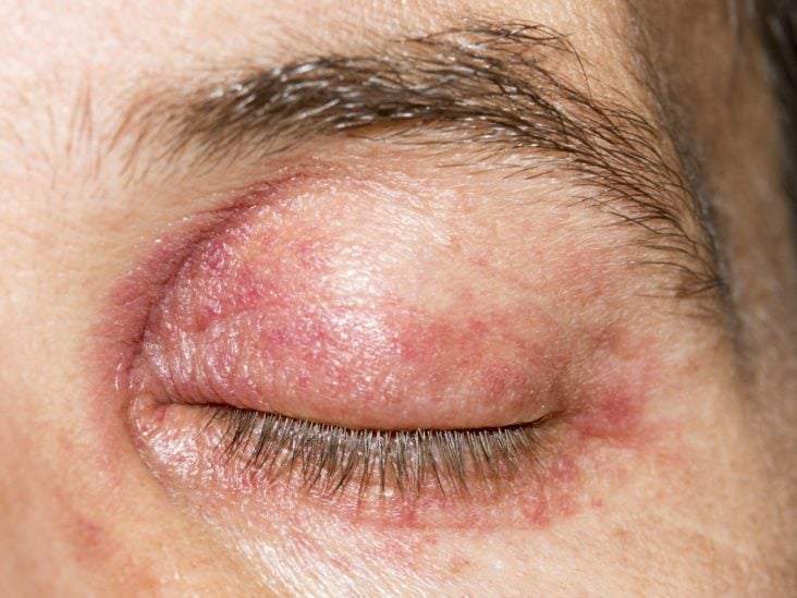 Eyelid dermatitis: Treatment, and