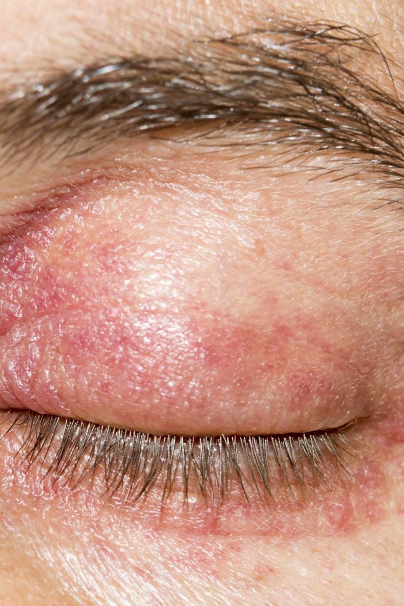 how to treat psoriasis on eyelid hogyan leplezhetik le az arc vörös foltjait otthon