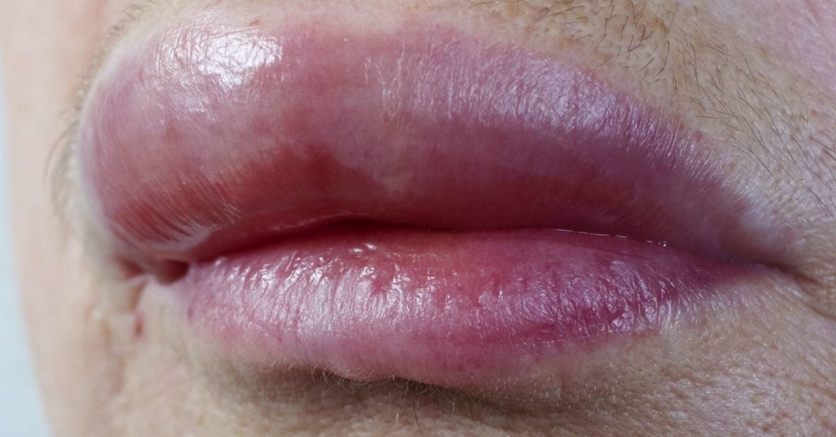 Swollen lips: Causes and treatment