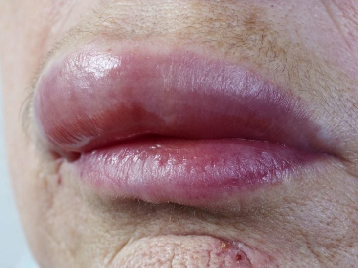 Allergy symptoms dry lips