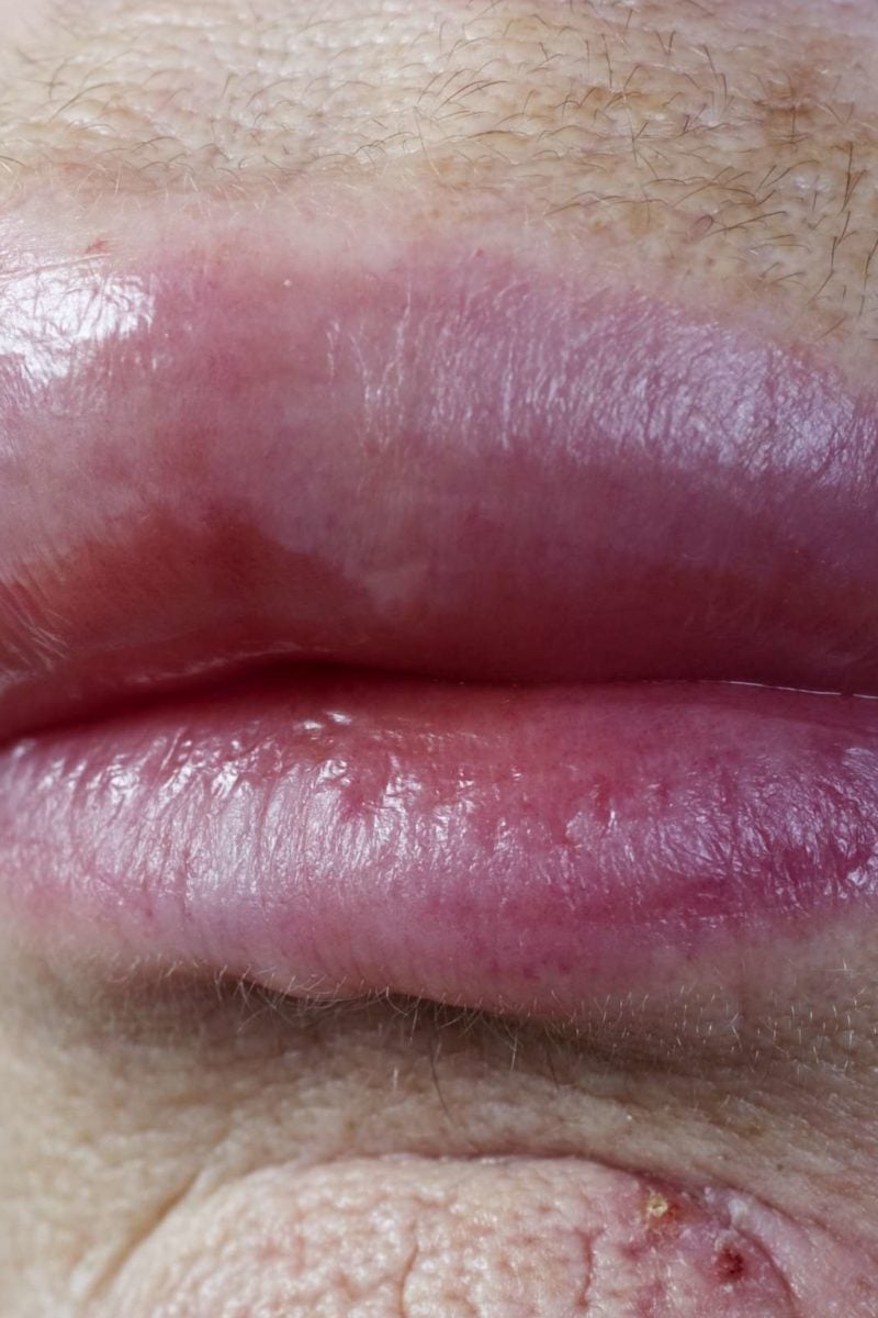 Swollen lips Causes and treatment