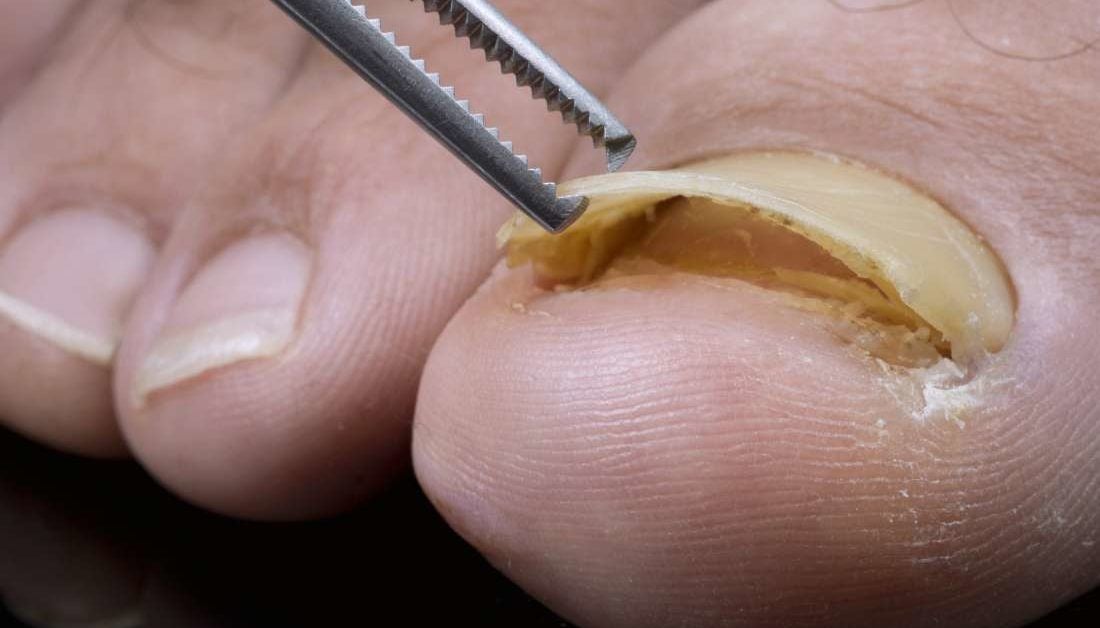 Toenail Falling Off What To Do Causes And Removal