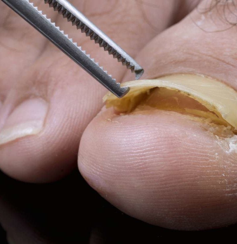 Toenail falling off: What to do, causes, and removal
