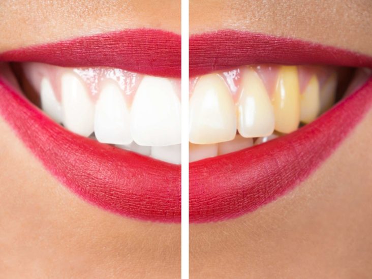 How to get rid of yellow teeth: 11 home remedies