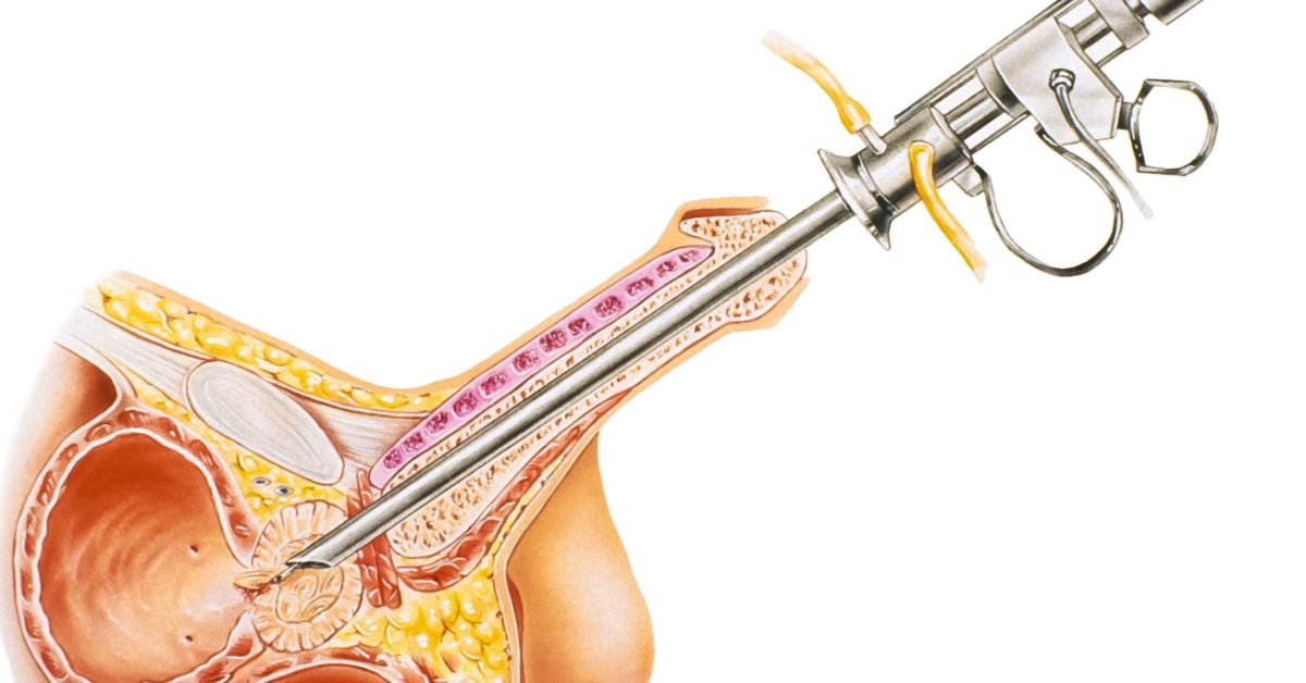 prostate gland surgery turp)