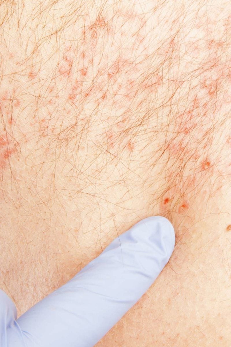 How Long Does A Shingles Rash Last