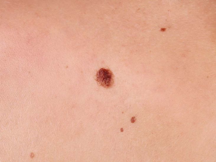 Tomat forbedre Forræderi Cherry angioma: Symptoms, causes, and treatment