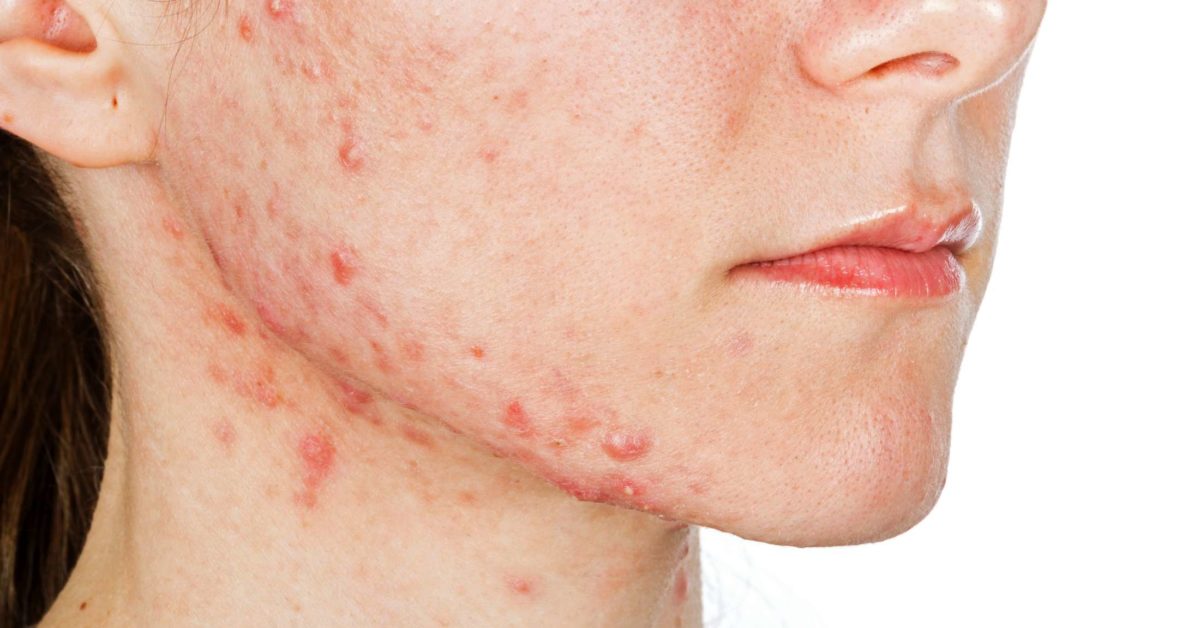 Jawline acne Causes, treatment and prevention