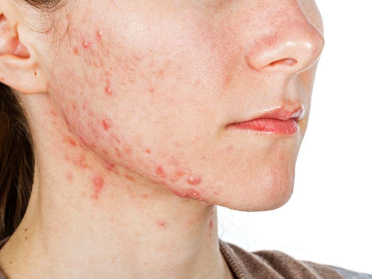 can a hormonal imbalance cause acne