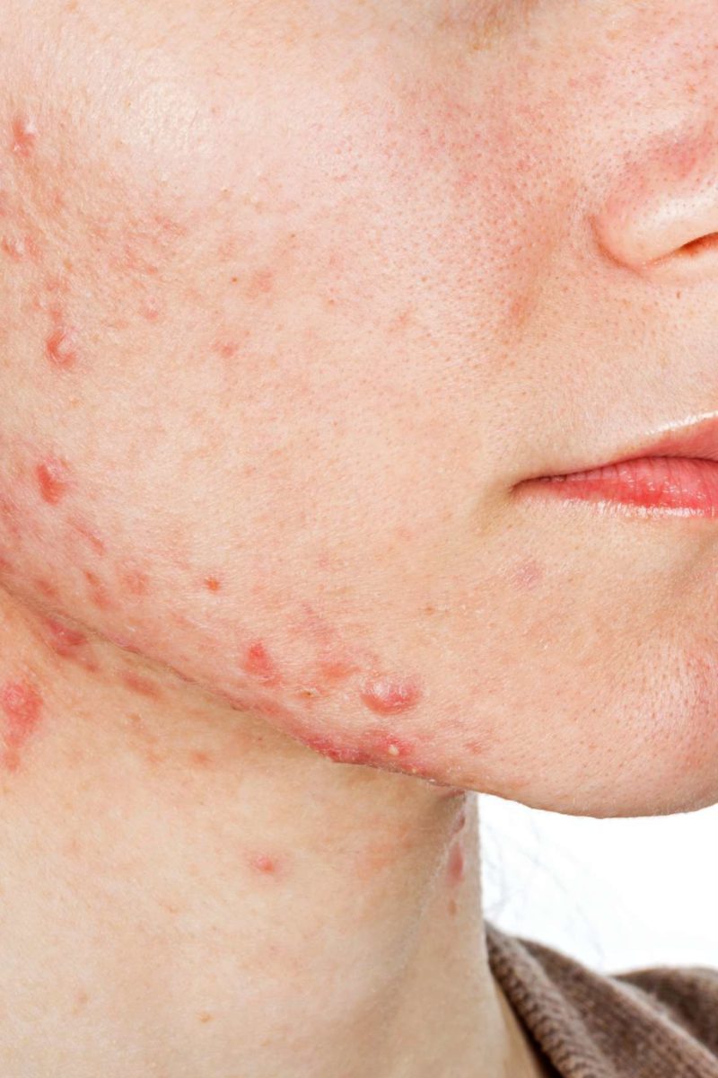 Jawline Acne Causes Treatment And Prevention