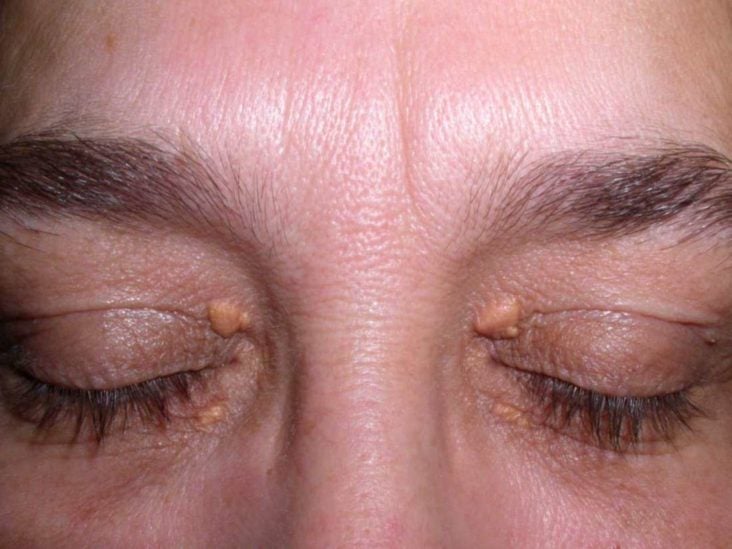 Xanthelasma What It Is Causes and Treatment