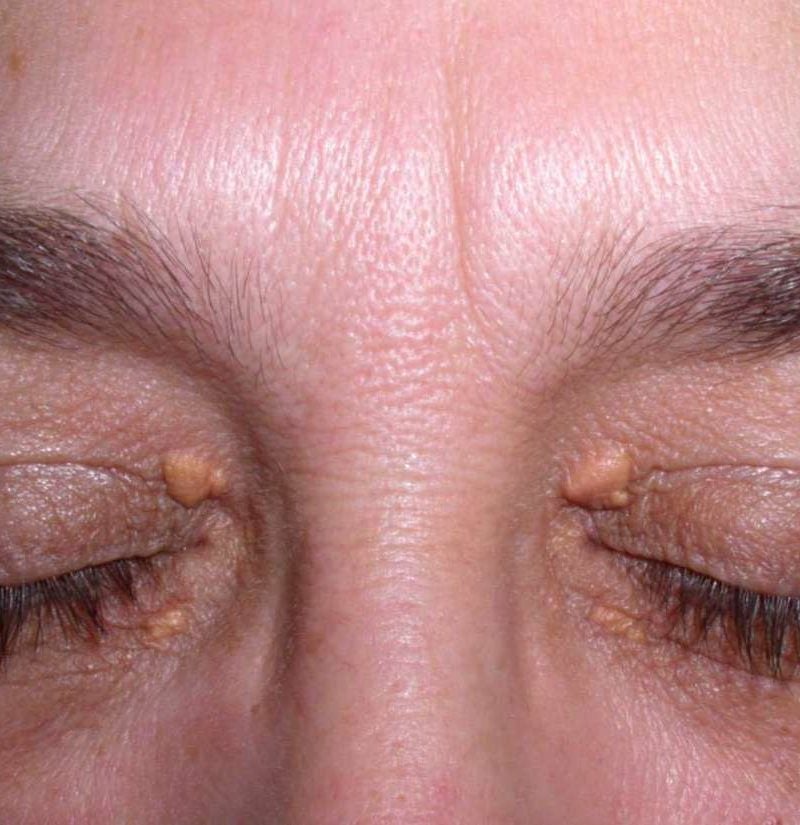 Albums 99+ Pictures pictures of cholesterol deposits on eyelids Latest