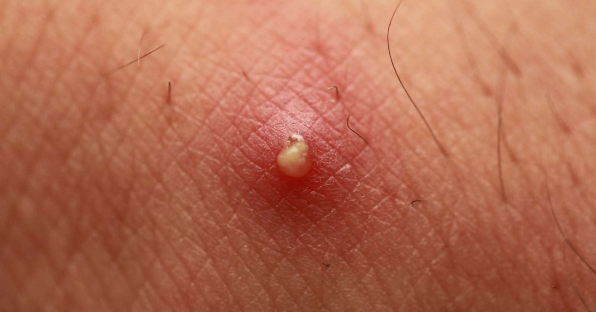 Popped pimple keeps filling with pus
