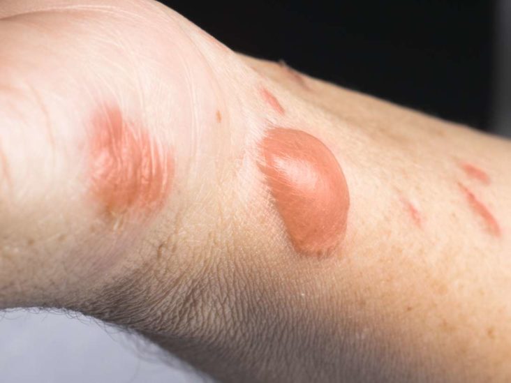 treating second degree burns