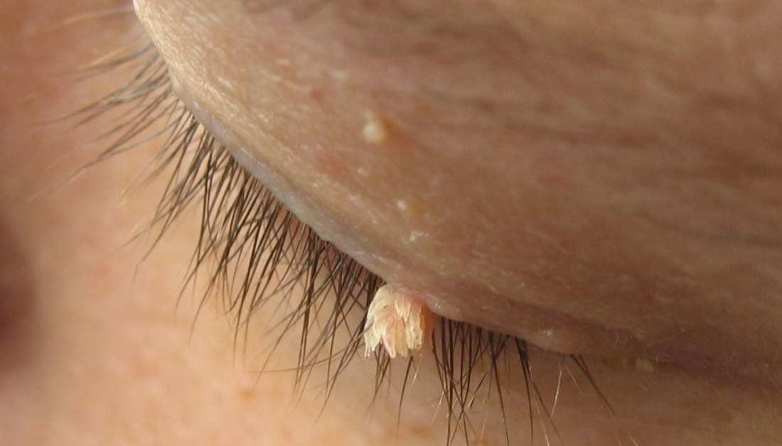 hpv wart removal includes