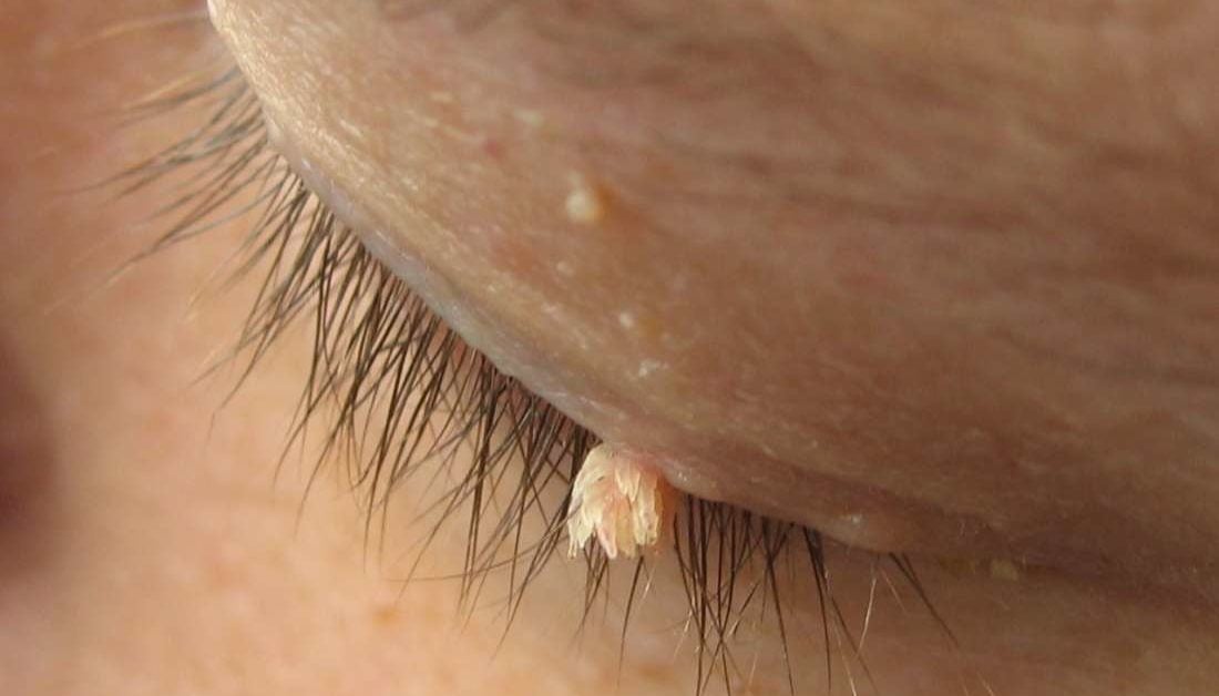 Papilloma wart on scalp