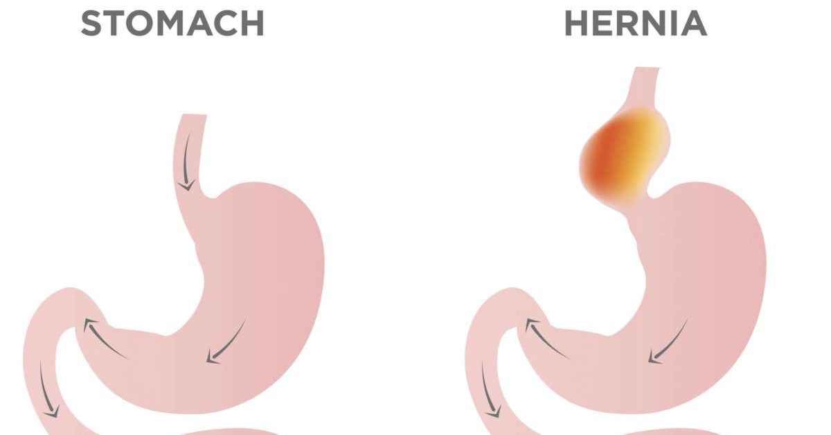 How Long Is The Recovery Time For Hiatal Hernia Surgery