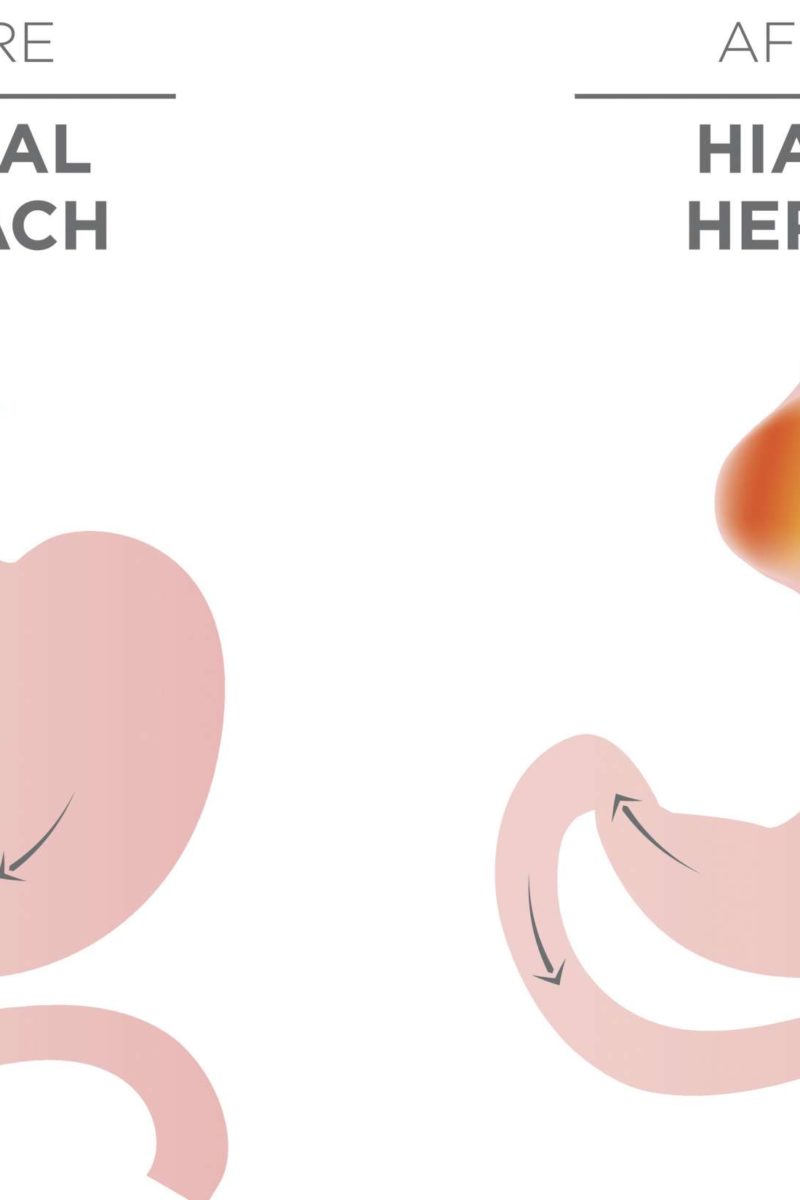 type 3 hiatal hernia