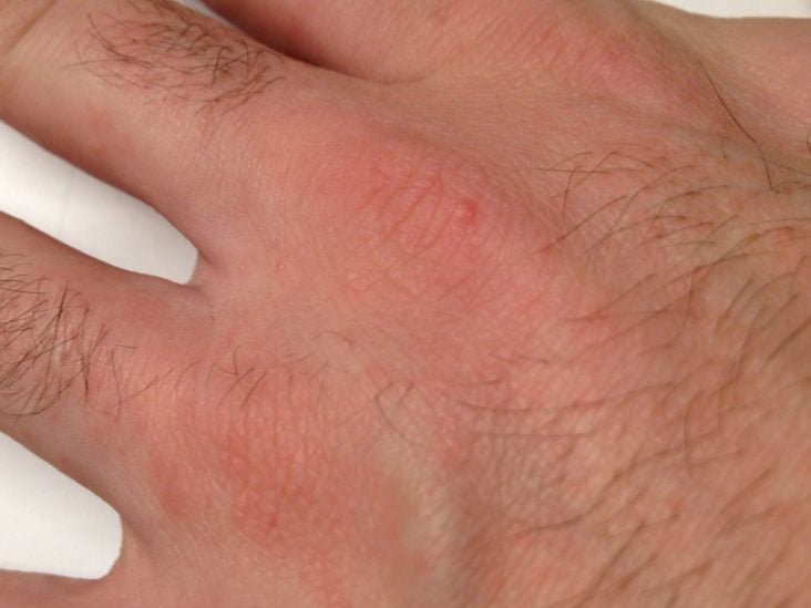 Scabies Symptoms