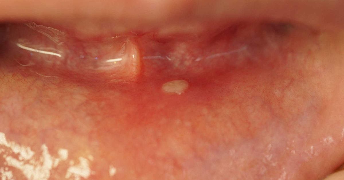 white gum infection