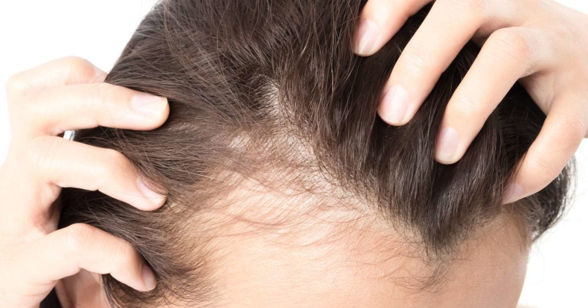 where does hair loss come from genetically