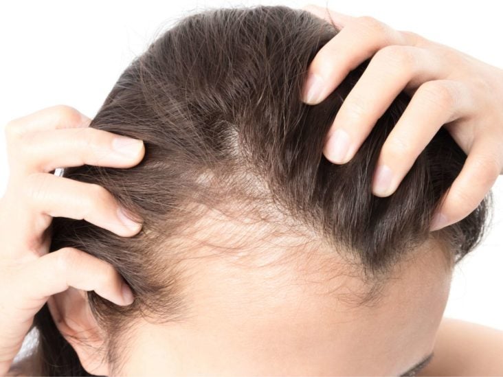 PCOS Hair Loss Best Treatments Regrow Lost Hair