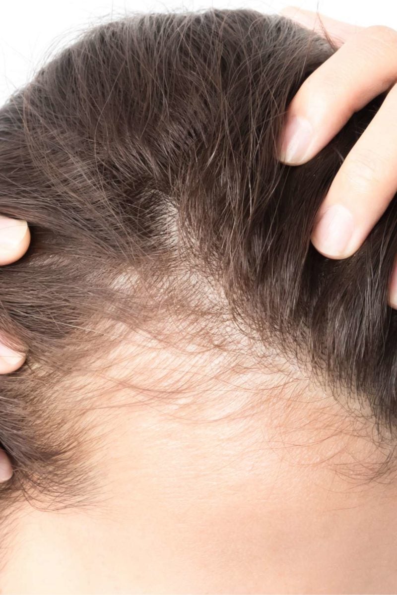 Understanding Alopecia Areata | Saint Luke's Health System