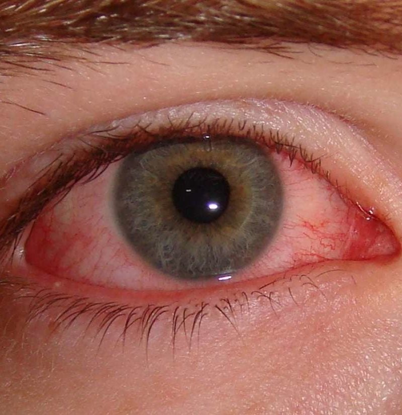 Fest Devise Forstå How long does pink eye last? 7 signs you are still contagious