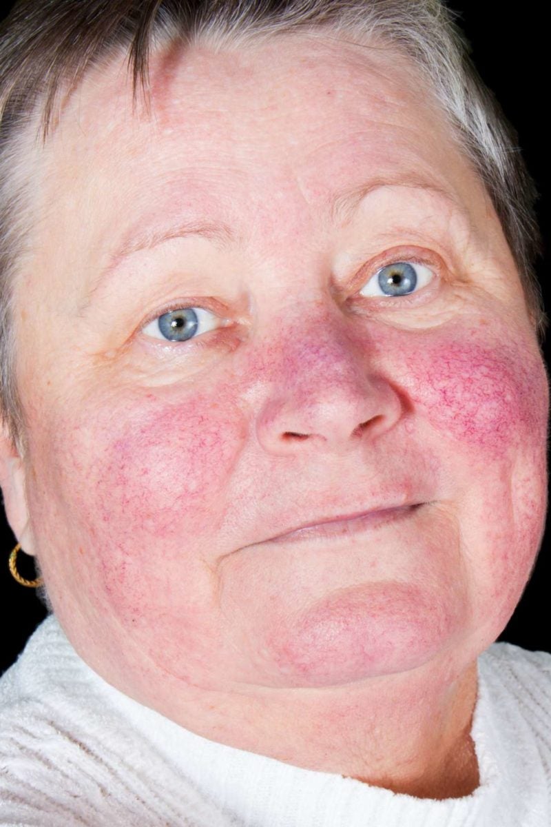 Ssurvivor Early Stage Mild Malar Rash