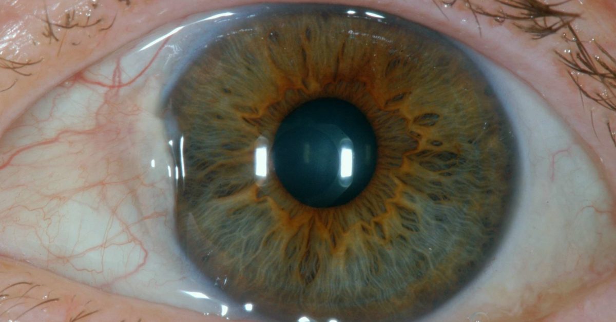 Bumps On Eyeball Causes Types And Treatment