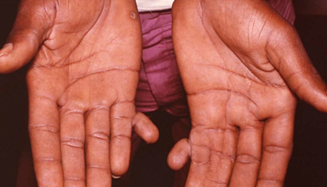 down syndrome hand characteristics