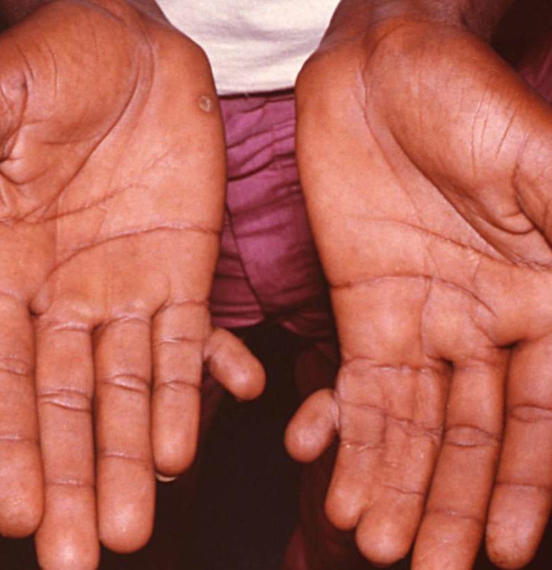 6 Fingers (Polydactylism): Why Are Some People Born With An Extra Digit?
