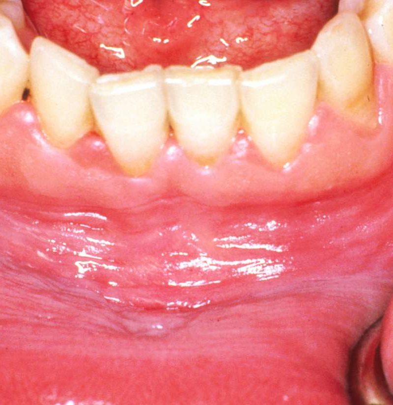 no healthy gums