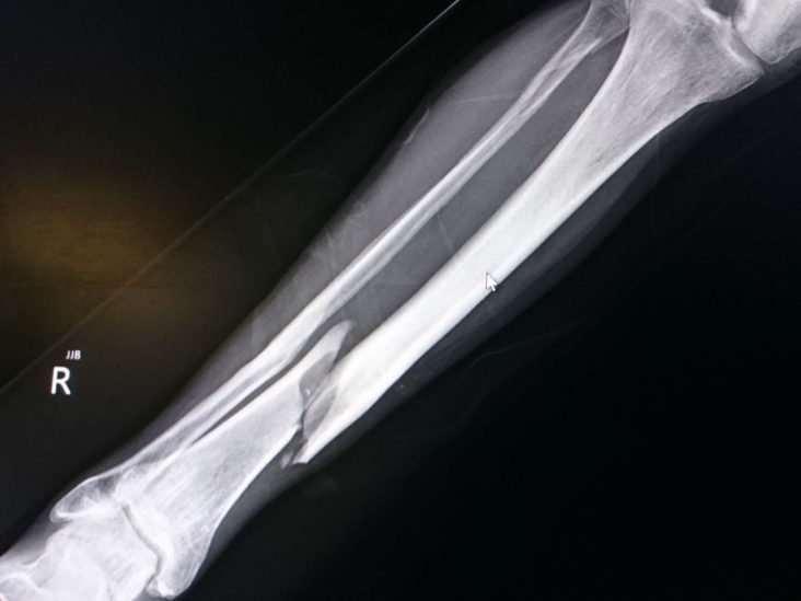 linear bone fracture