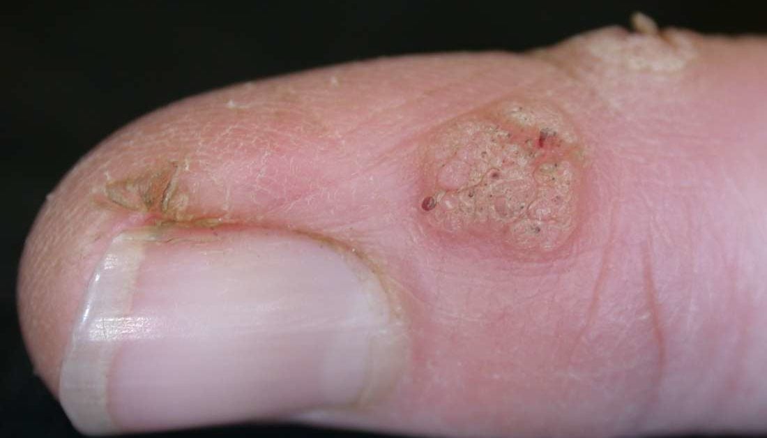 hpv warts left untreated)