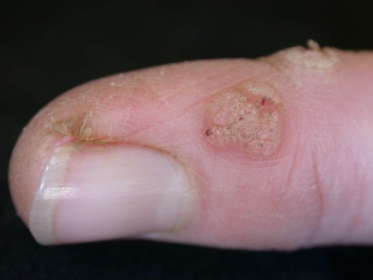 wart after virus