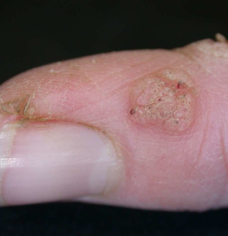 Periungual warts Pictures, treatment, and prevention