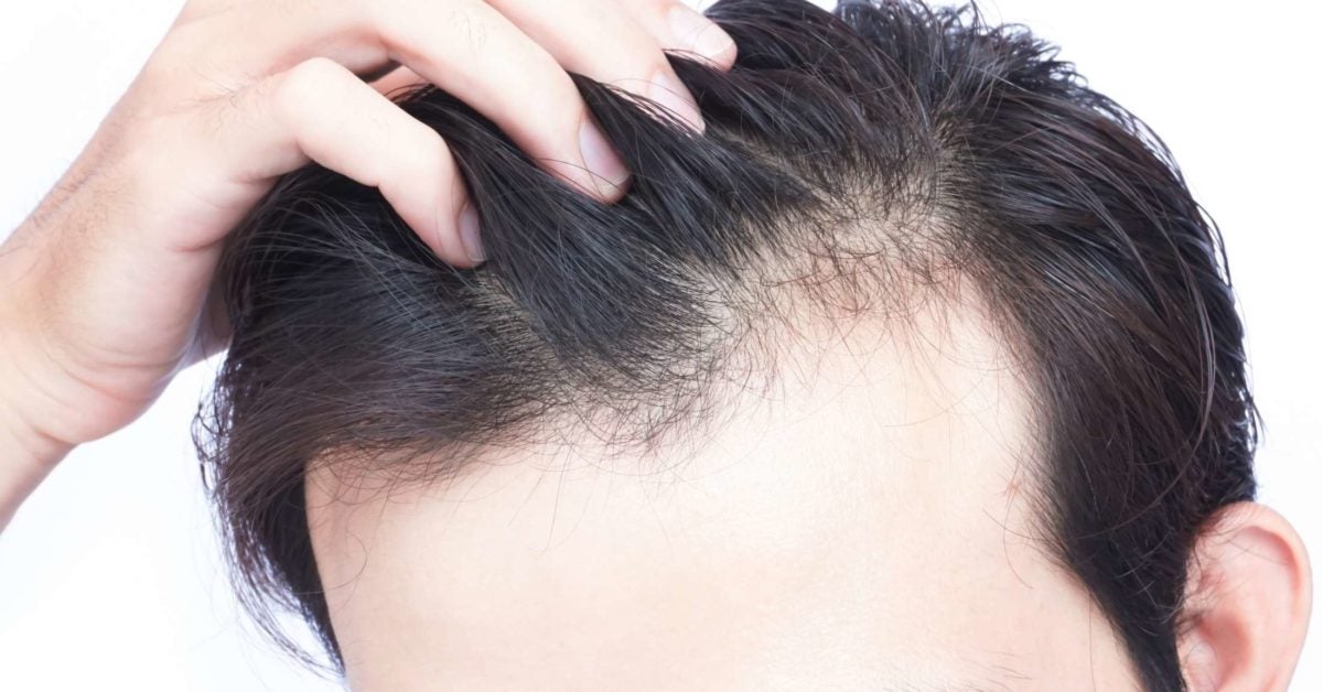 vitamin-d-deficiency-hair-loss-symptoms-and-treatment