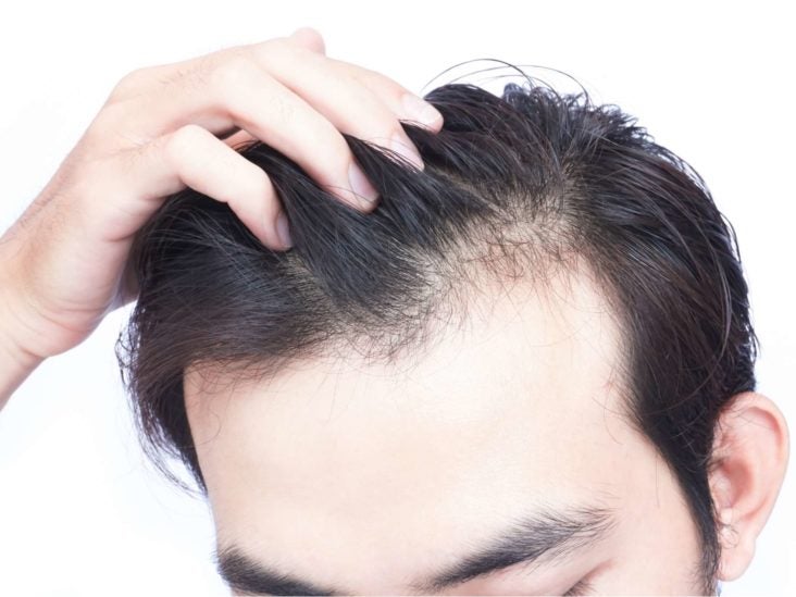 PRP for hair loss Does it work and is it safe