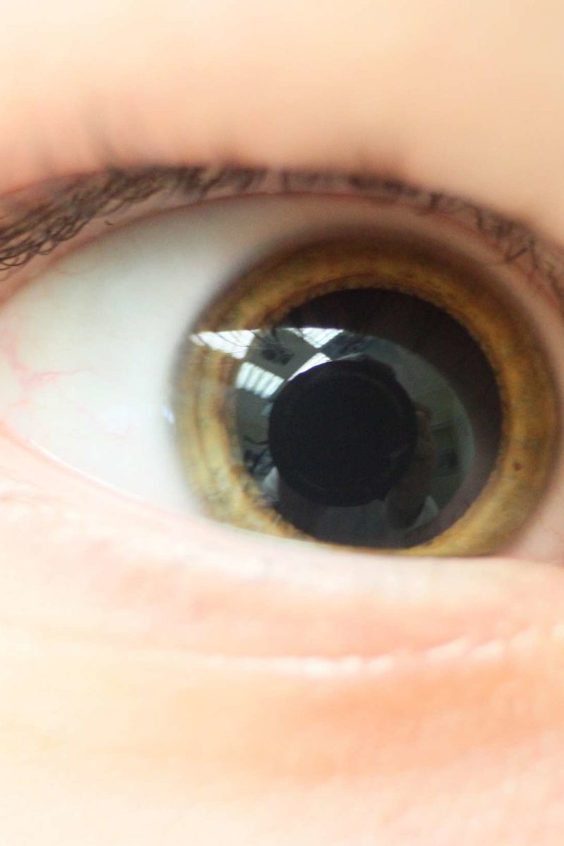 dilated pupils vs normal