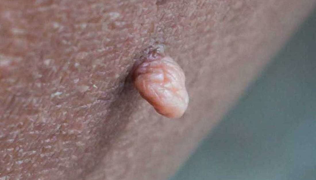 vaginal skin irritation