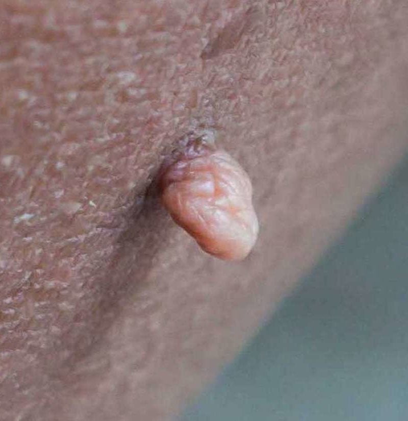 helminthiasis de sunpin pe corp apar alunițe de papilom