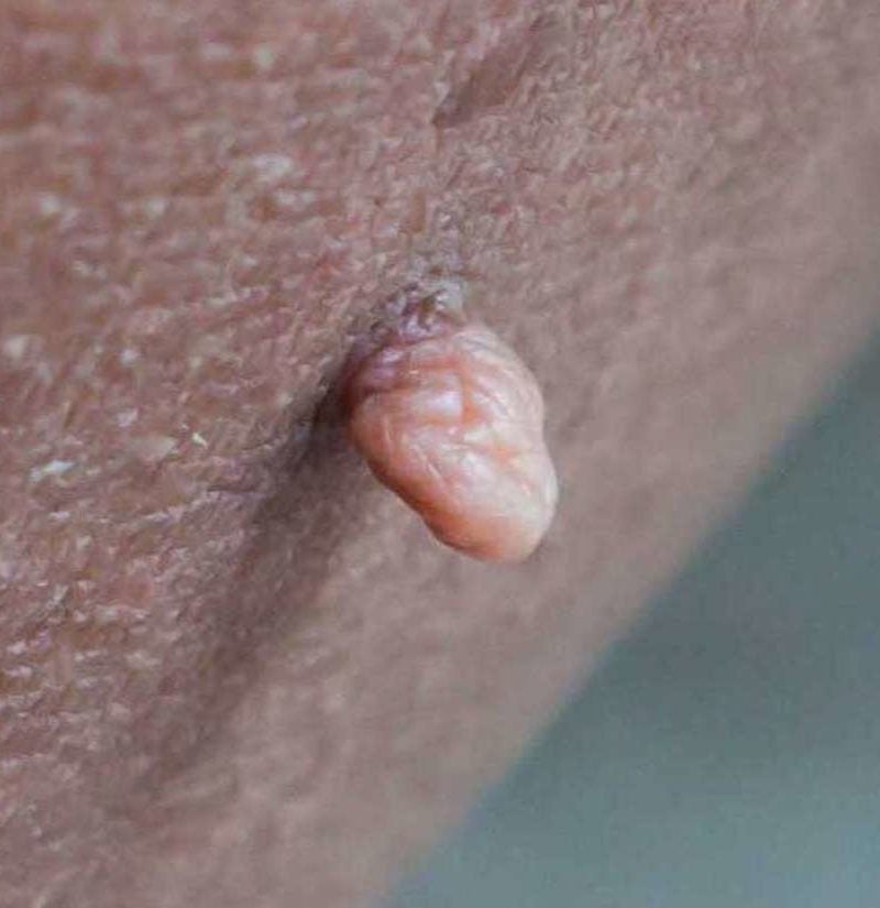 vaginal skin tags on lip