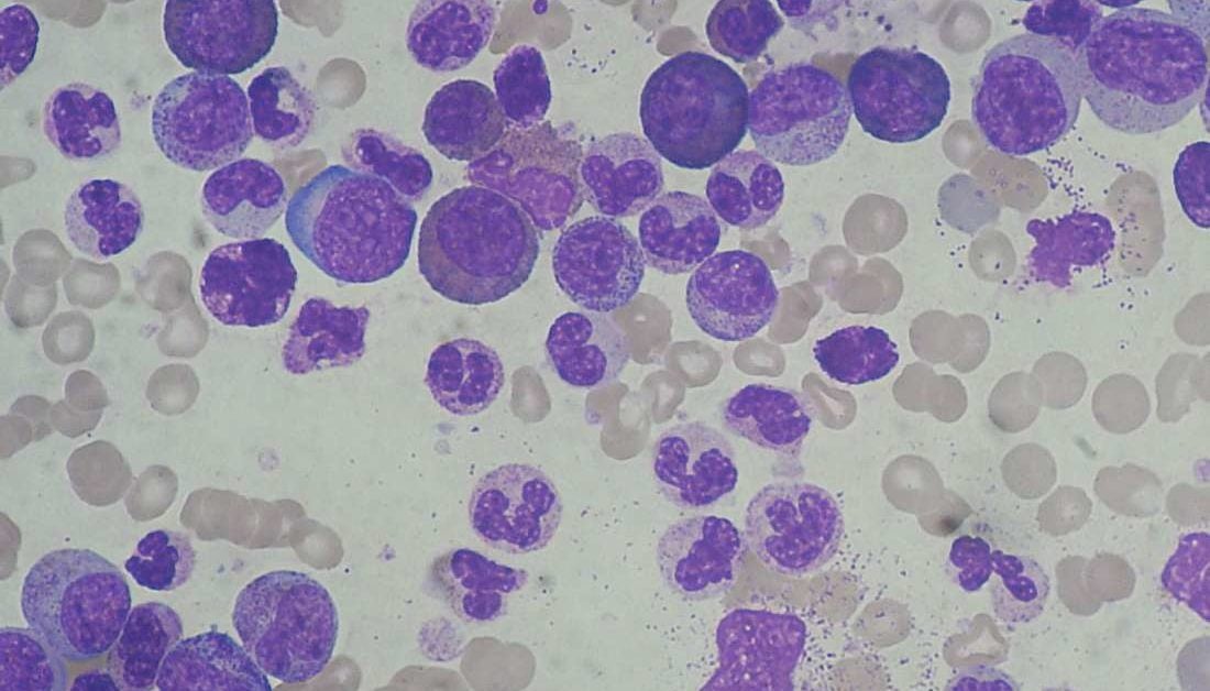 Leukemia Vs Lymphoma Similarities And Differences