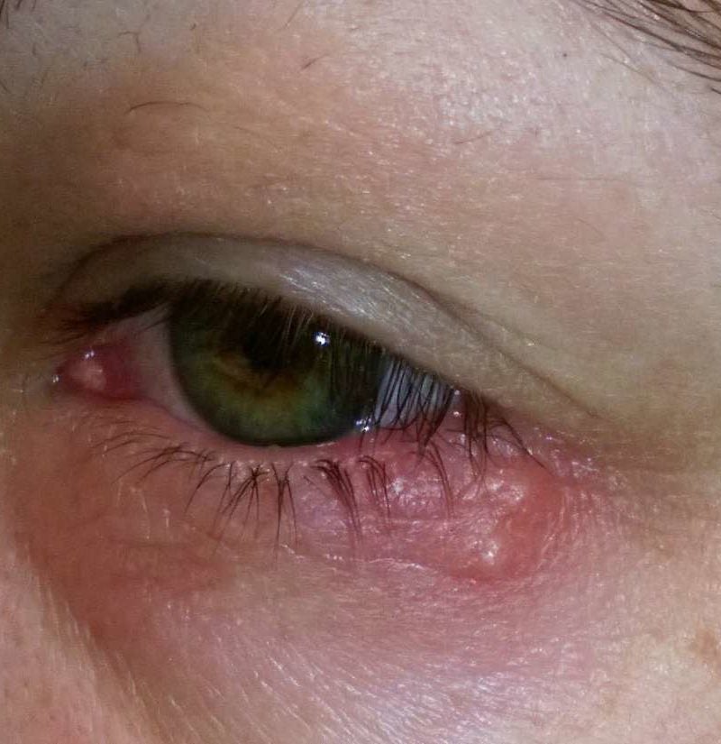 Eye herpes: Pictures, symptoms, and