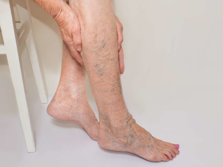 varicoza foot tratament folk remedy
