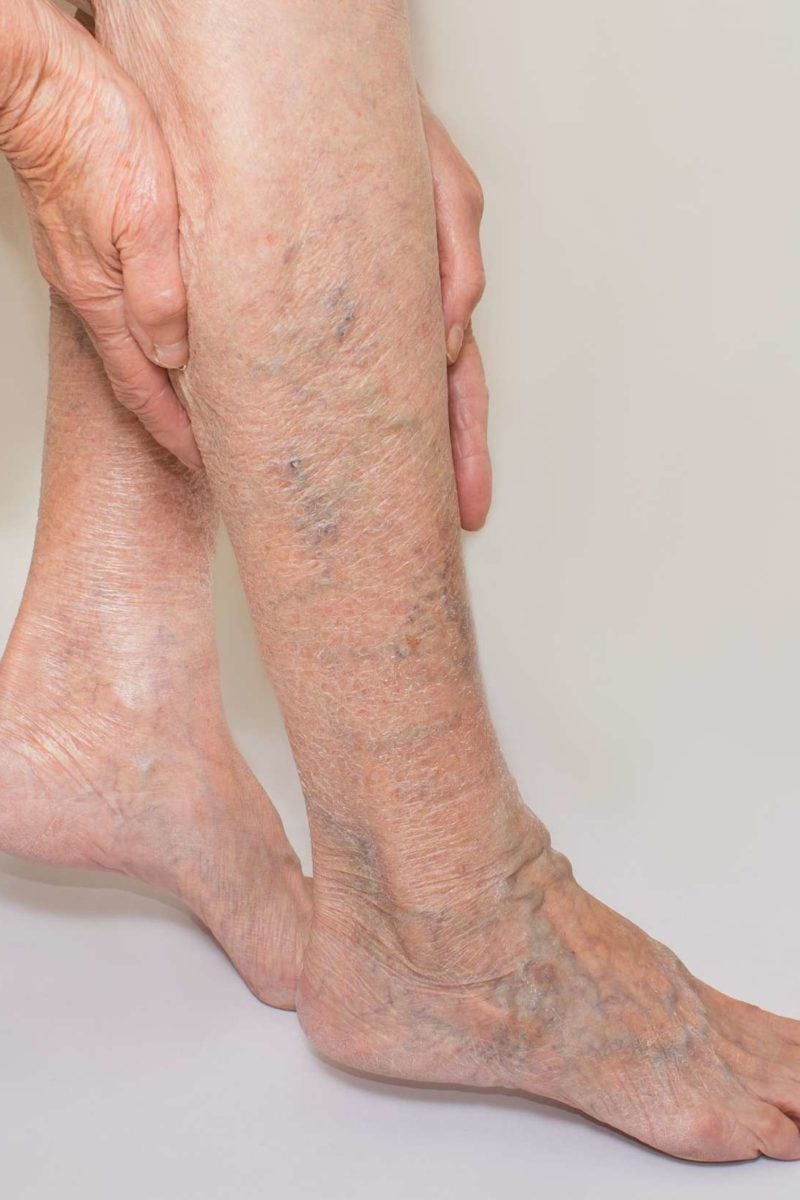 tratamentul genunchiului varicos