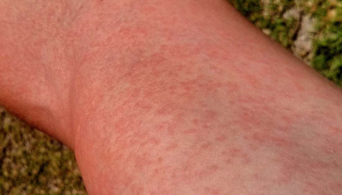 maculopapular rash hands