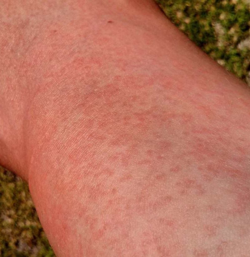 maculopapular-rash-causes-treatment-and-pictures